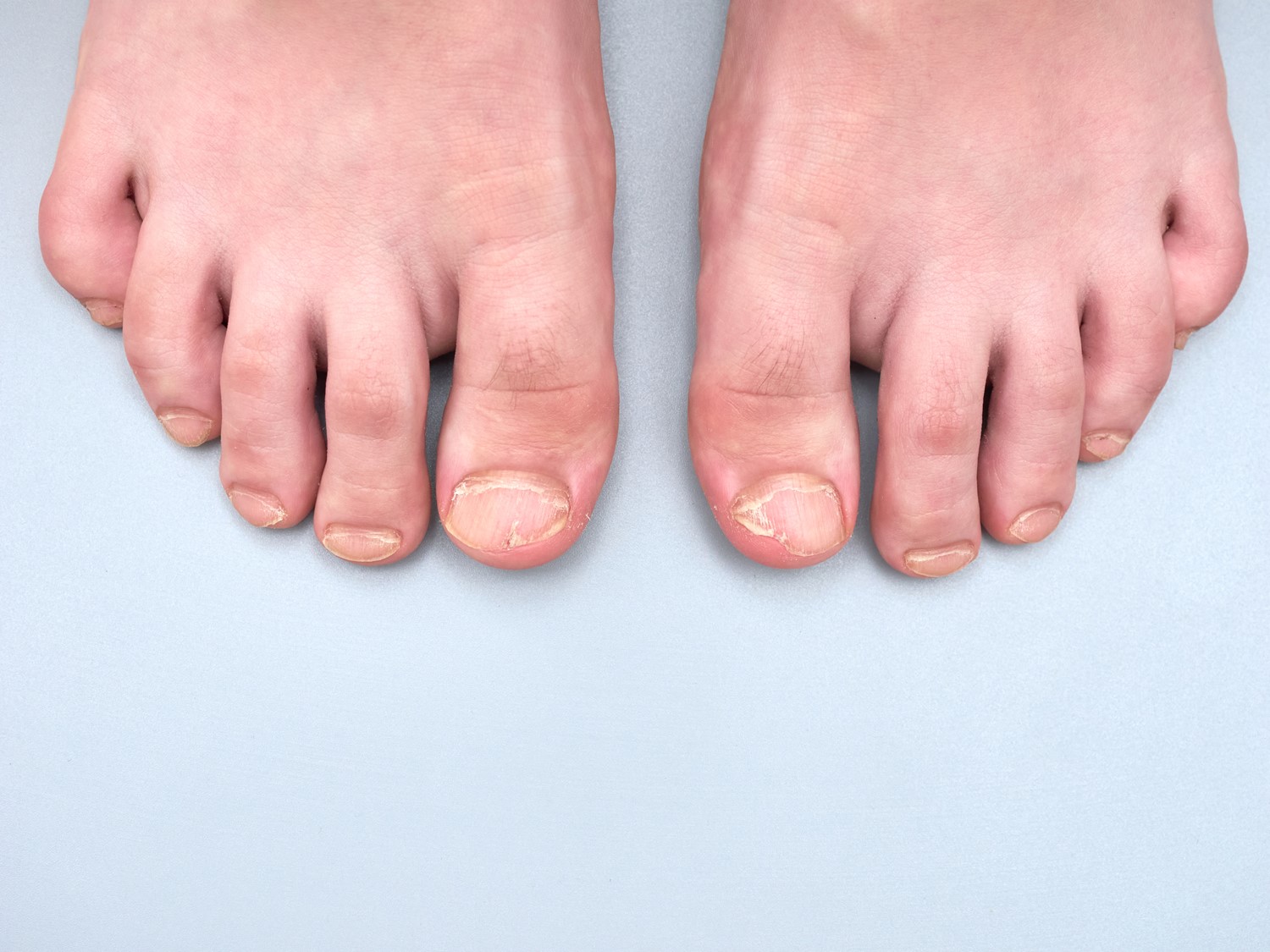 ingrown-toenails-explained-frequently-asked-questions-and-expert