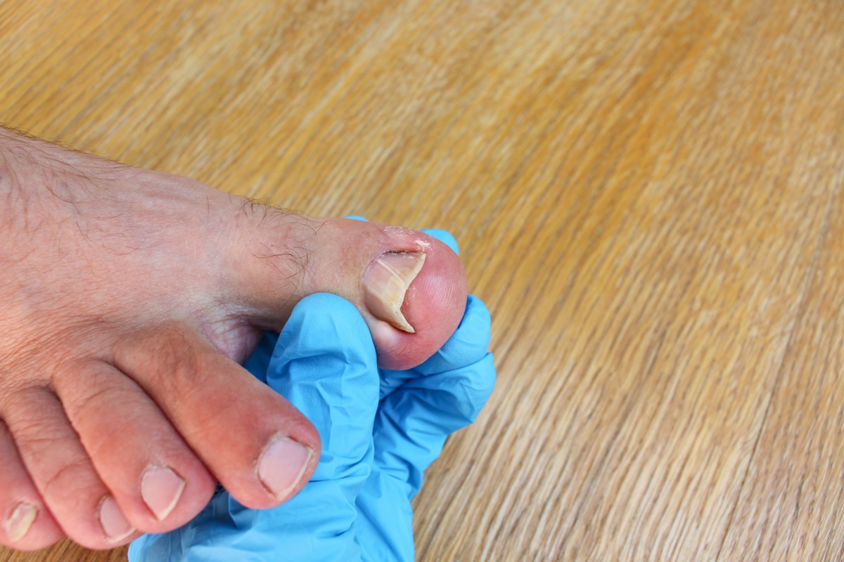 understanding-ingrown-toenails-causes-symptoms-and-treatment-options