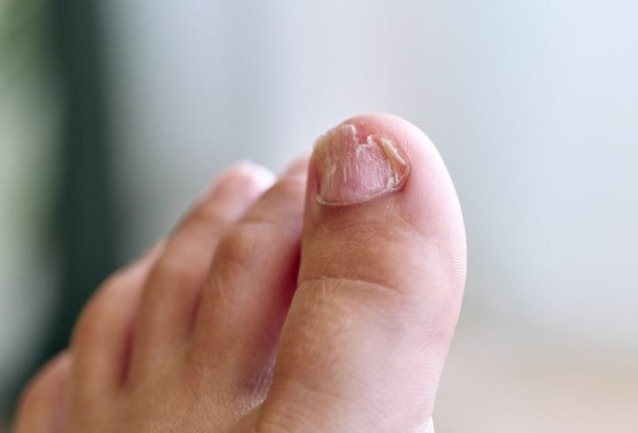 Ingrown Toenails 1