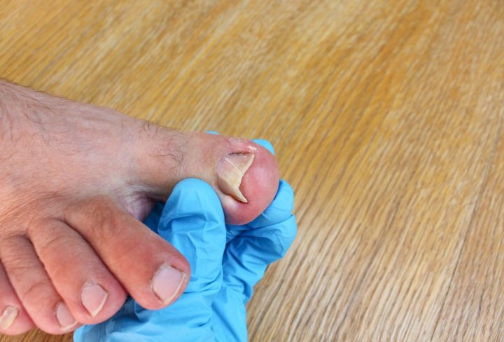 Ingrown Toenails